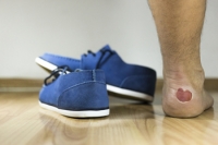 Can Blisters on the Feet Be Prevented?