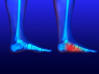 Symptoms of Flat Feet