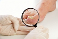 Should I See a Doctor for Toenail Fungus?