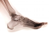 Why Do Stress Fractures Occur?