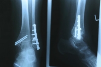 What Happens When a Stress Fracture Occurs?